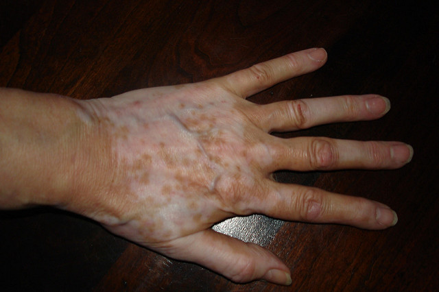 A vitiligo kezelése fontos feladat
